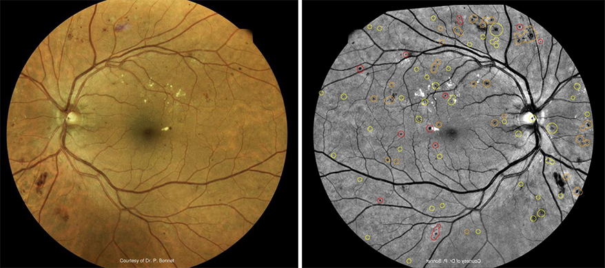 20/20NOW Implements Retinal AI In All Of Its Ocular Telehealth Exams