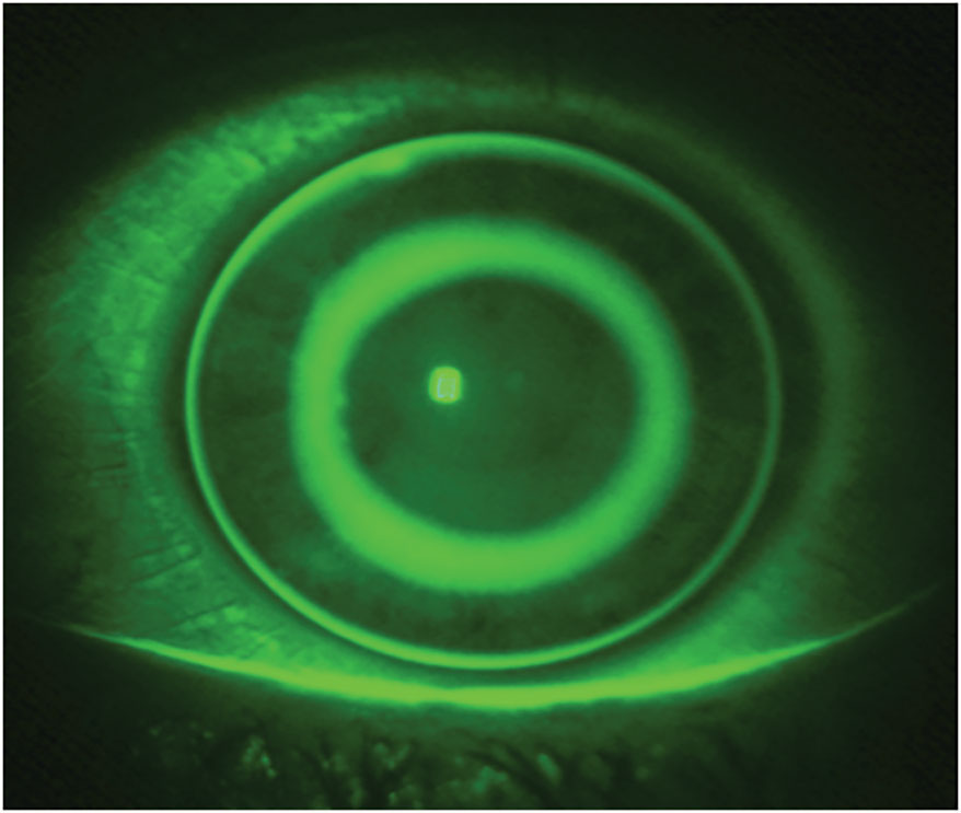 Art Optical MOONLENS Overnight Orthokeratology Contact Lens System