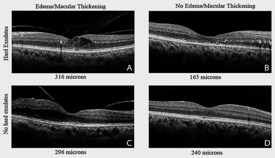 biomarkers in four types of diabetic eyes