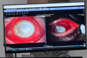 Don’t Give Flesh Eating Bacteria the Opportunity to Feast on Your Cornea