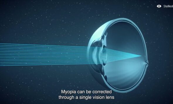 Essilor&reg; Stellest&reg; Lenses